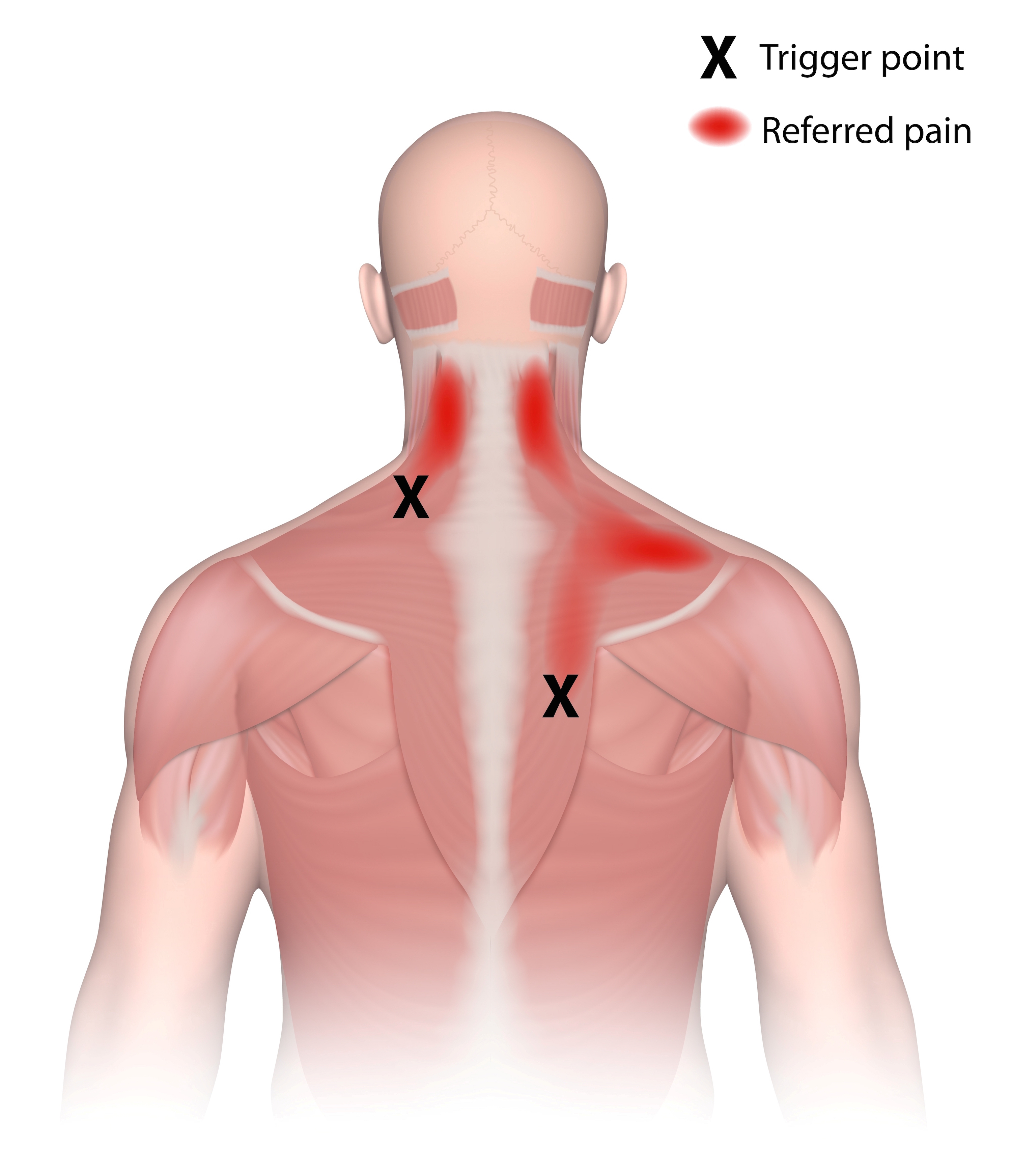 psoas pain referral pattern